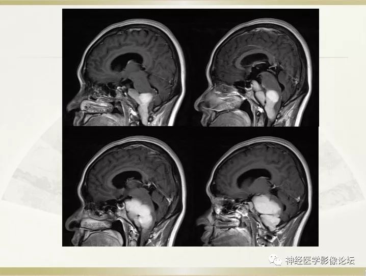 【病例】左侧CPA区肠源性囊肿1例CT及MR影像表现