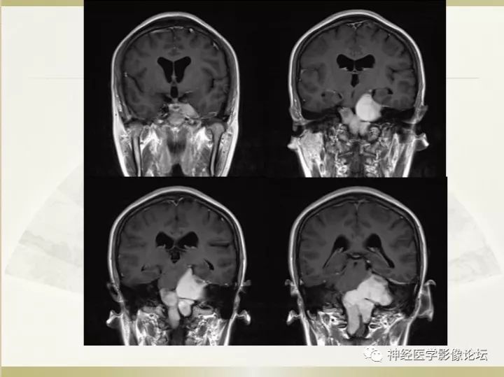 【病例】左侧CPA区肠源性囊肿1例CT及MR影像表现