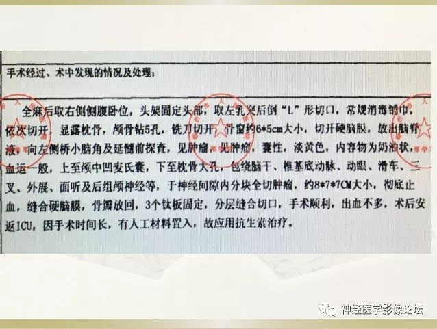 【病例】左侧CPA区肠源性囊肿1例CT及MR影像表现