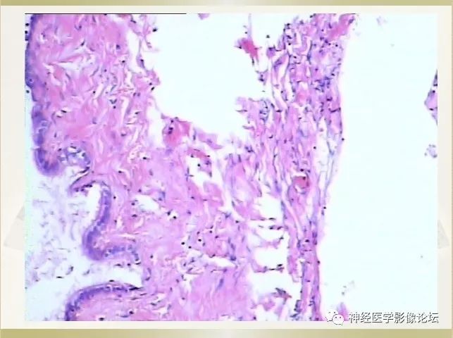 【病例】左侧CPA区肠源性囊肿1例CT及MR影像表现