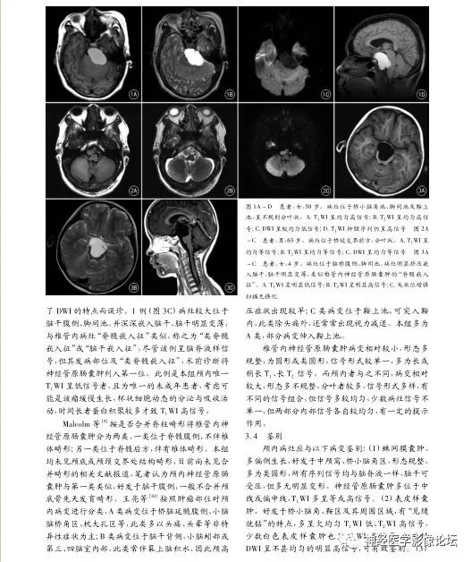 【病例】左侧CPA区肠源性囊肿1例CT及MR影像表现