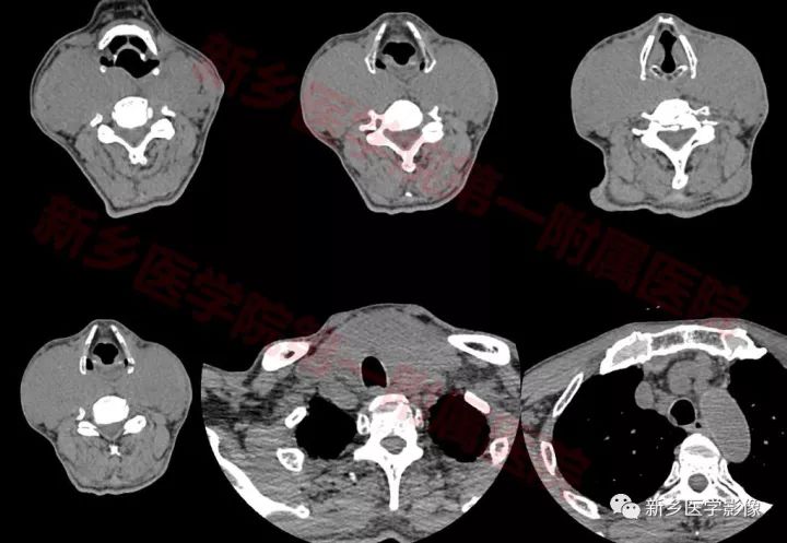 【病例】原发性甲状腺淋巴瘤1例CT影像表现 【病例】原发性甲状腺淋巴瘤1例CT影像表现