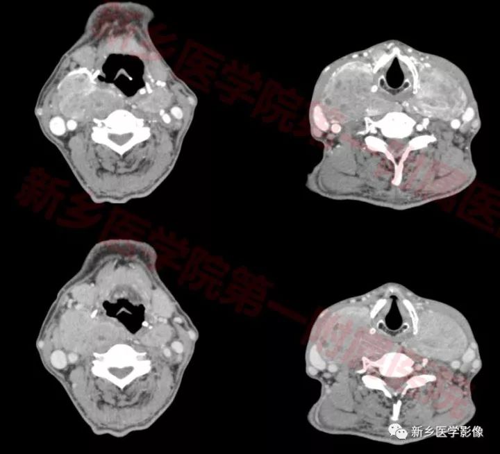 【病例】原发性甲状腺淋巴瘤1例CT影像表现
