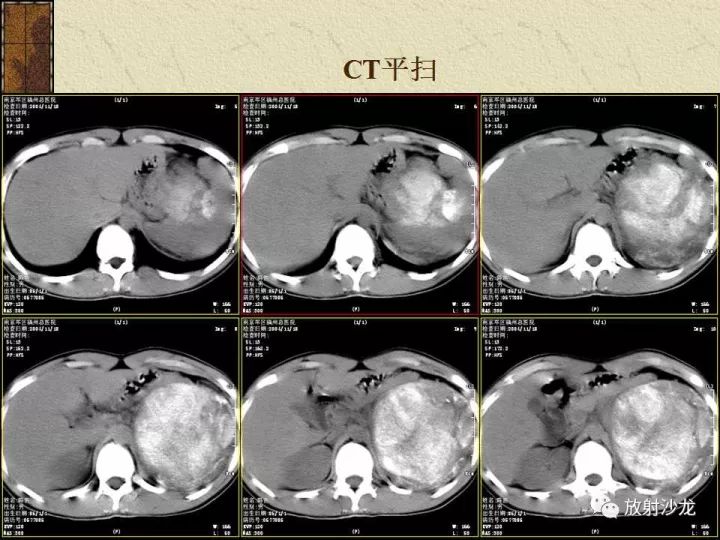 【病例】腹膜后PNET一例CT影像表现