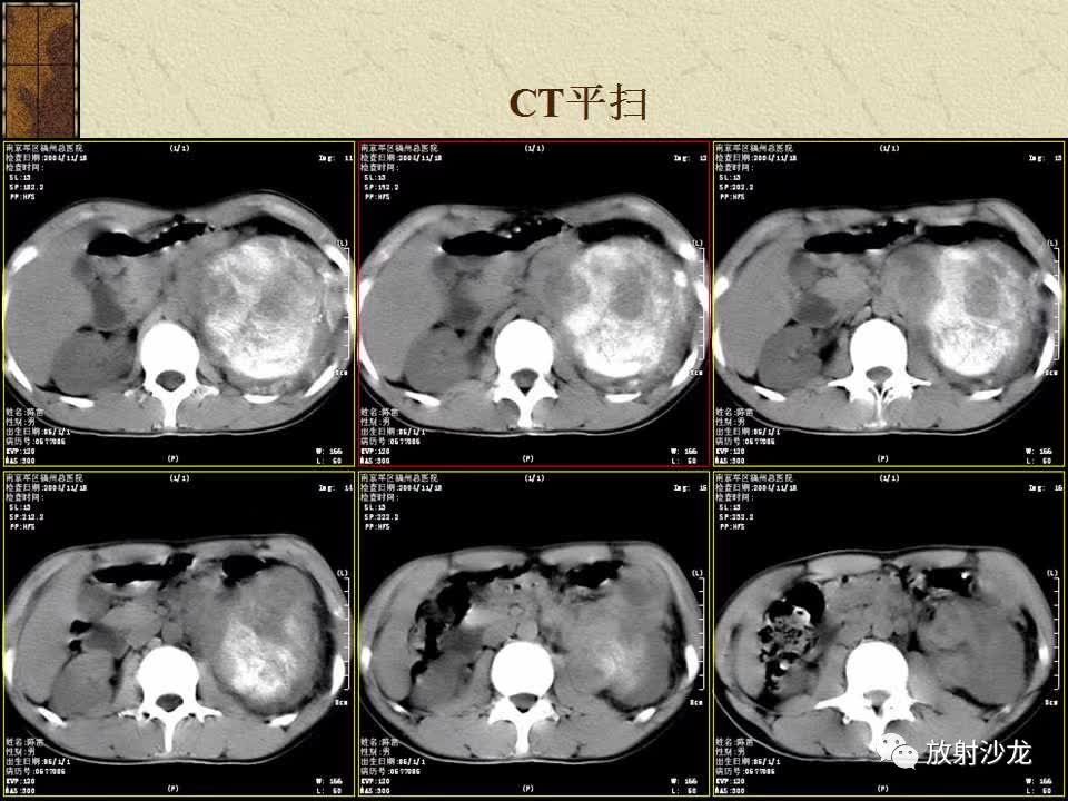 【病例】腹膜后PNET一例CT影像表现