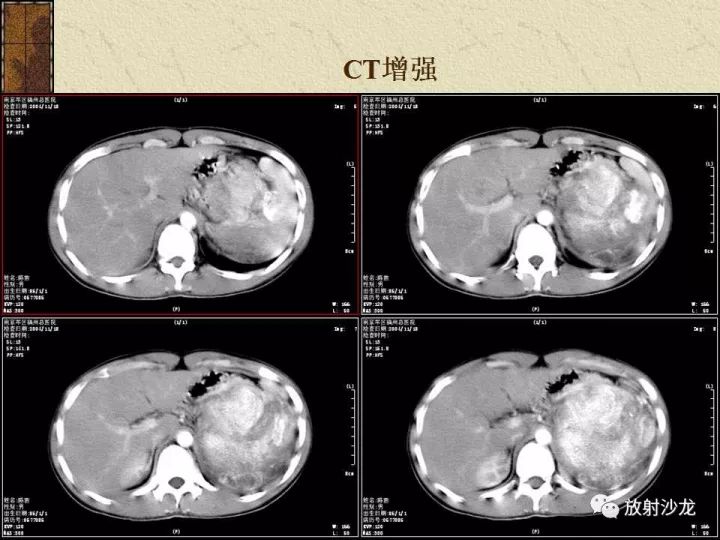 【病例】腹膜后PNET一例CT影像表现