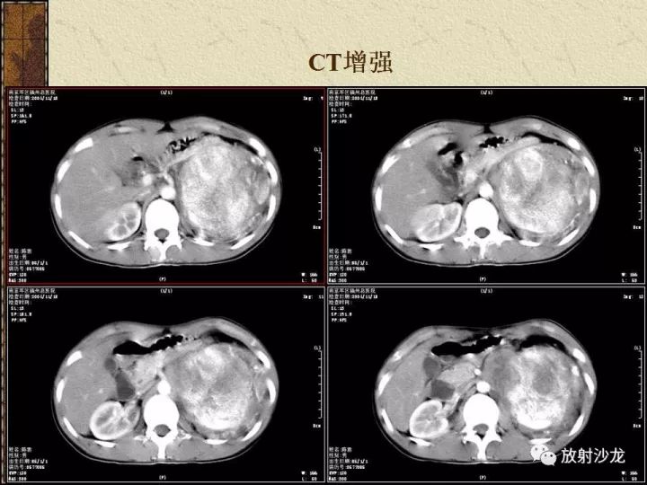 【病例】腹膜后PNET一例CT影像表现