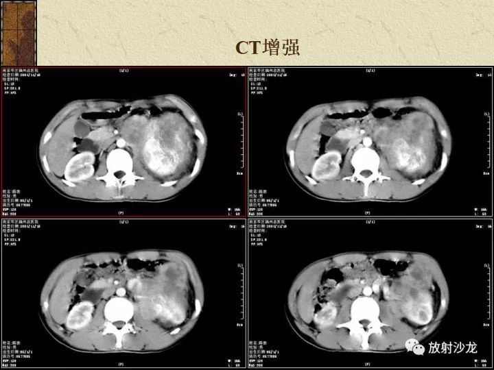【病例】腹膜后PNET一例CT影像表现