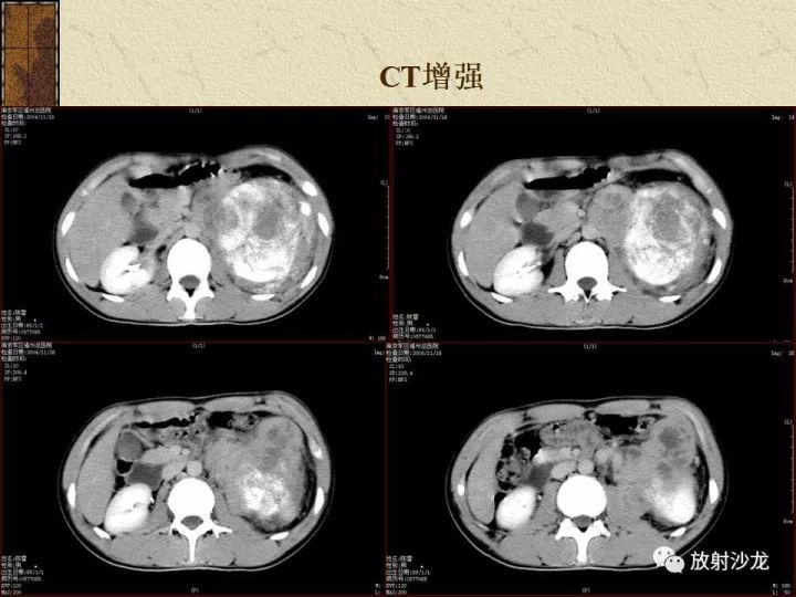 【病例】腹膜后PNET一例CT影像表现