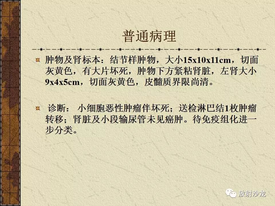 【病例】腹膜后PNET一例CT影像表现
