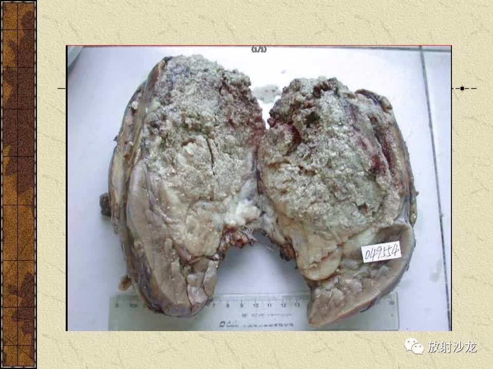 【病例】腹膜后PNET一例CT影像表现