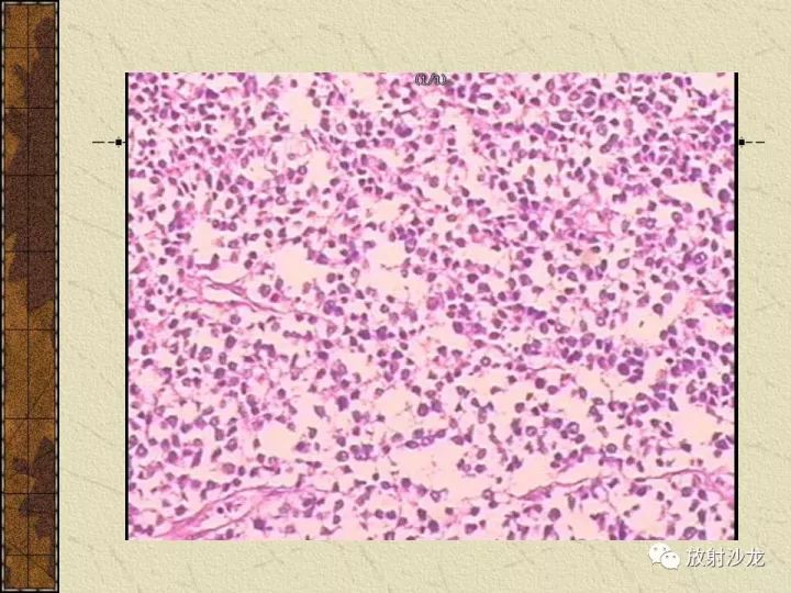 【病例】腹膜后PNET一例CT影像表现