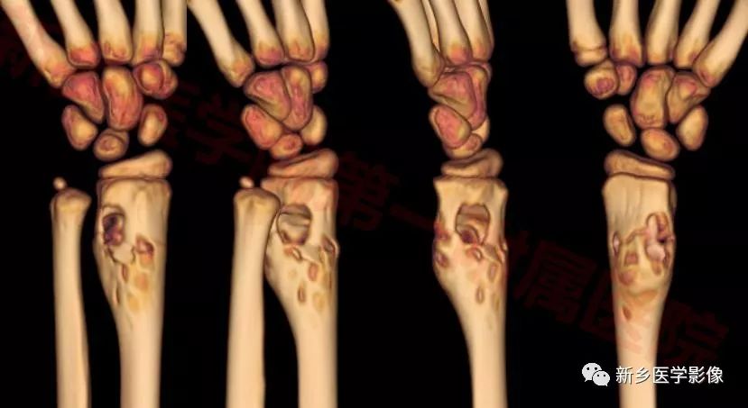 【病例】桡骨良性纤维组织细胞瘤1例X线CT及MR影像表现 【病例】桡骨良性纤维组织细胞瘤1例X线CT及MR影像表现