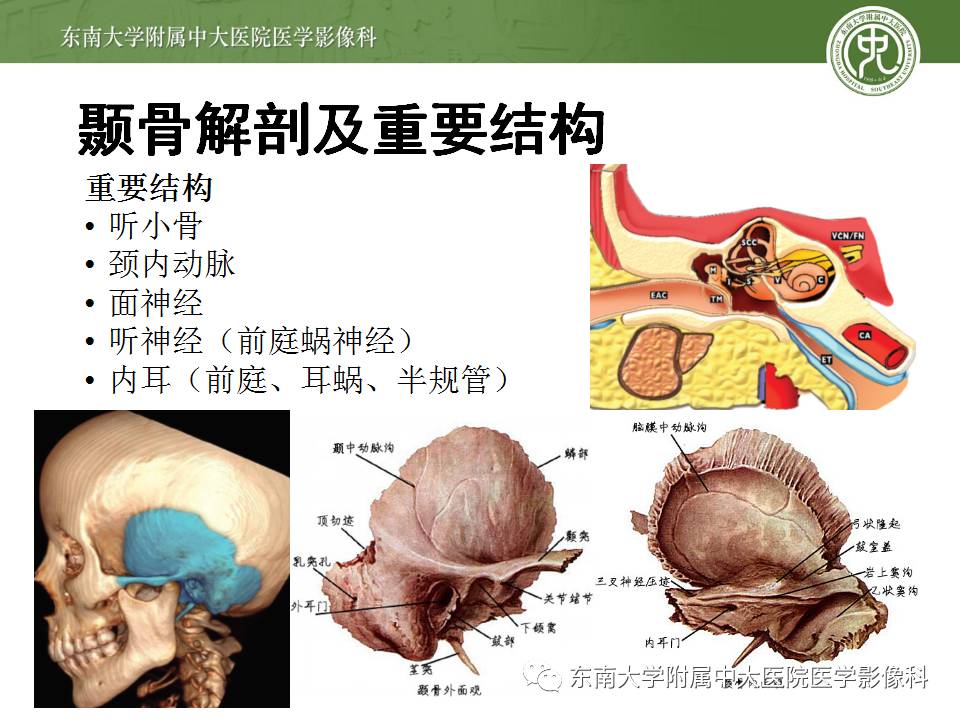 【病例】颞骨骨折2例影像诊断 【病例】颞骨骨折2例影像诊断