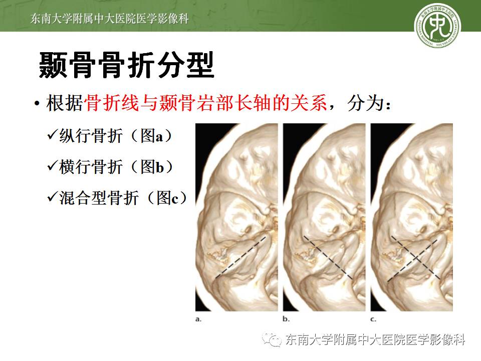 【病例】颞骨骨折2例影像诊断 【病例】颞骨骨折2例影像诊断