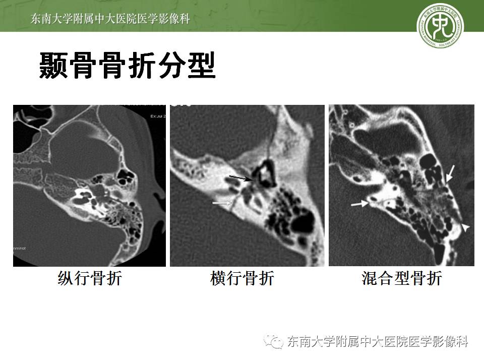 【病例】颞骨骨折2例影像诊断 【病例】颞骨骨折2例影像诊断