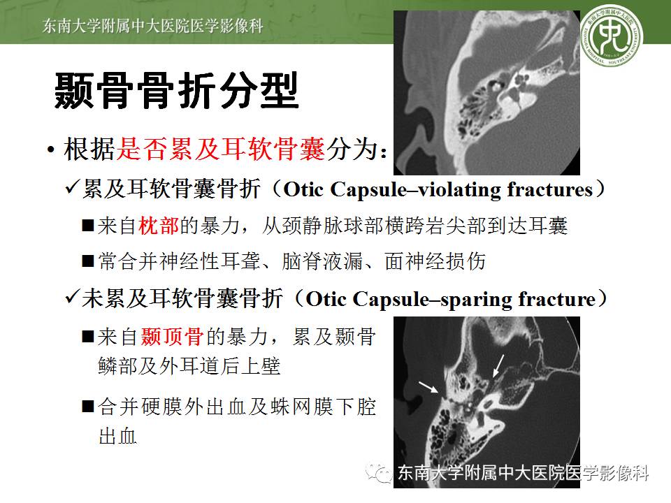 【病例】颞骨骨折2例影像诊断 【病例】颞骨骨折2例影像诊断