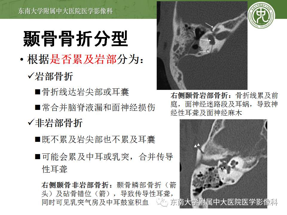 【病例】颞骨骨折2例影像诊断 【病例】颞骨骨折2例影像诊断