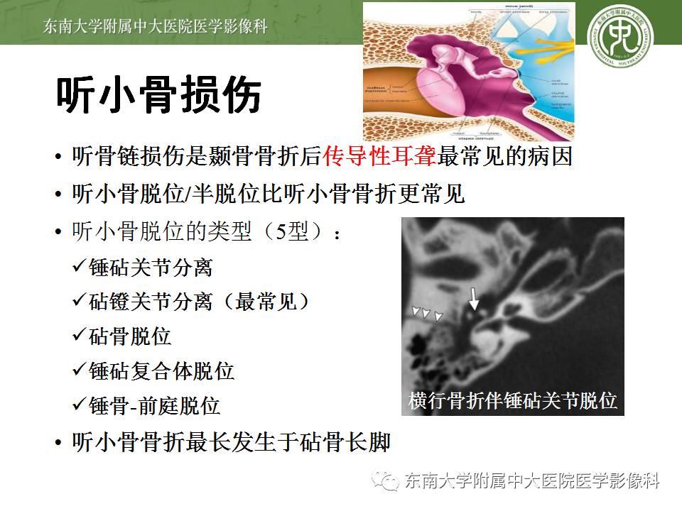 【病例】颞骨骨折2例影像诊断 【病例】颞骨骨折2例影像诊断