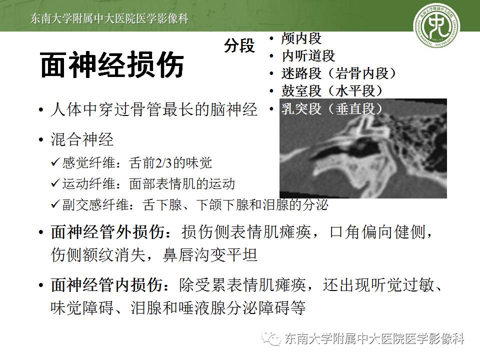【病例】颞骨骨折2例影像诊断 【病例】颞骨骨折2例影像诊断
