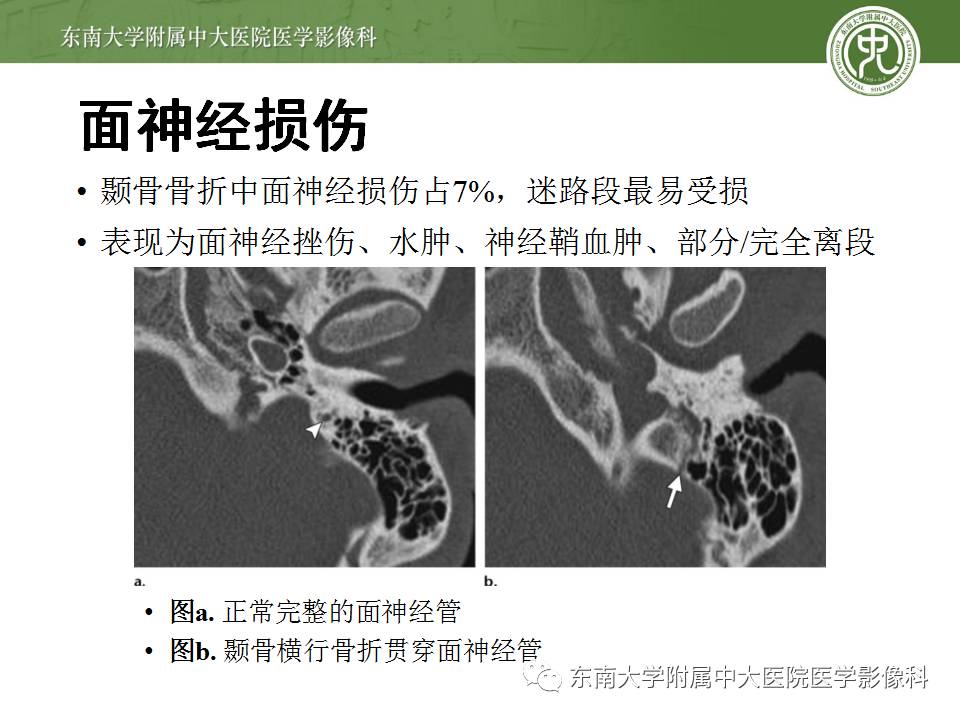 【病例】颞骨骨折2例影像诊断 【病例】颞骨骨折2例影像诊断