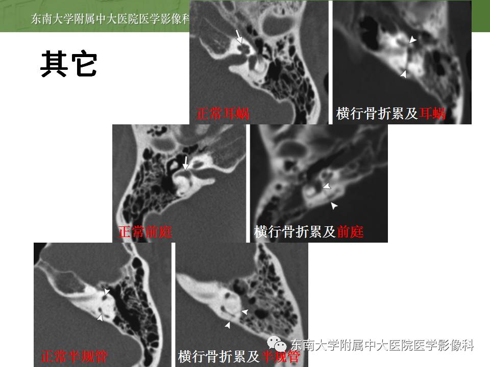 【病例】颞骨骨折2例影像诊断 【病例】颞骨骨折2例影像诊断
