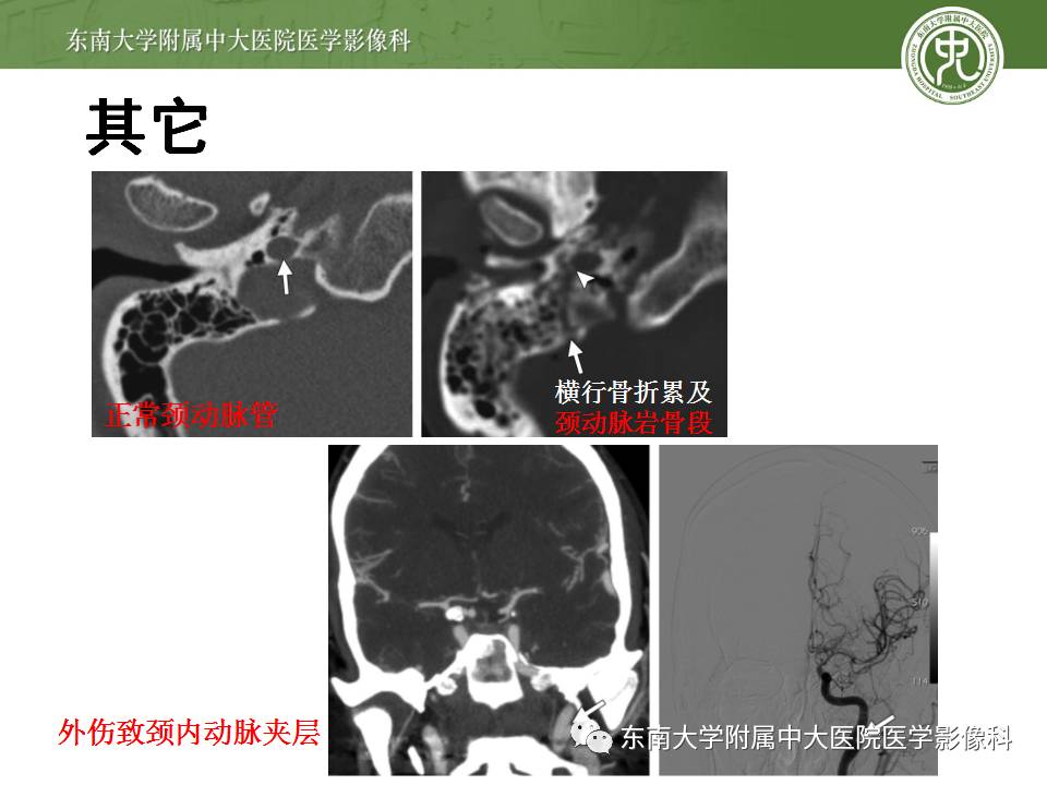 【病例】颞骨骨折2例影像诊断 【病例】颞骨骨折2例影像诊断