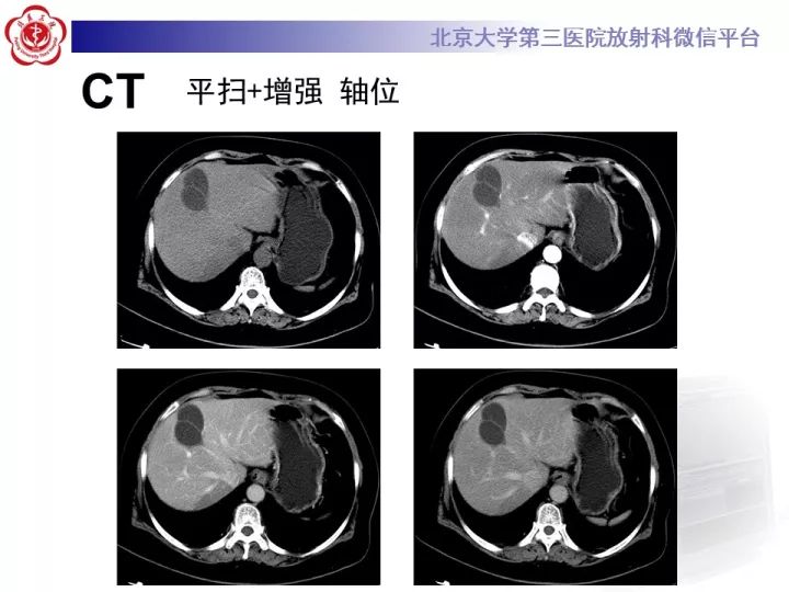 【病例】肝内胆管囊腺瘤1例CT及MR影像诊断