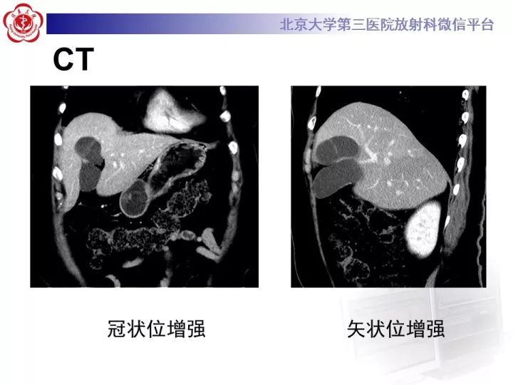 【病例】肝内胆管囊腺瘤1例CT及MR影像诊断