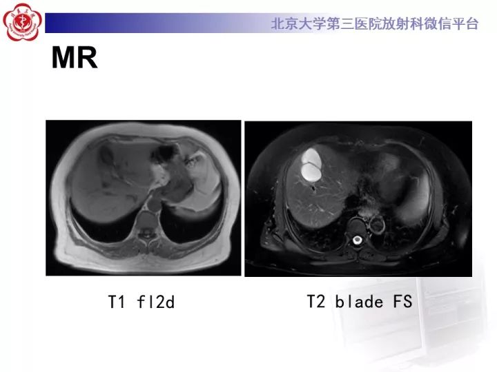 【病例】肝内胆管囊腺瘤1例CT及MR影像诊断