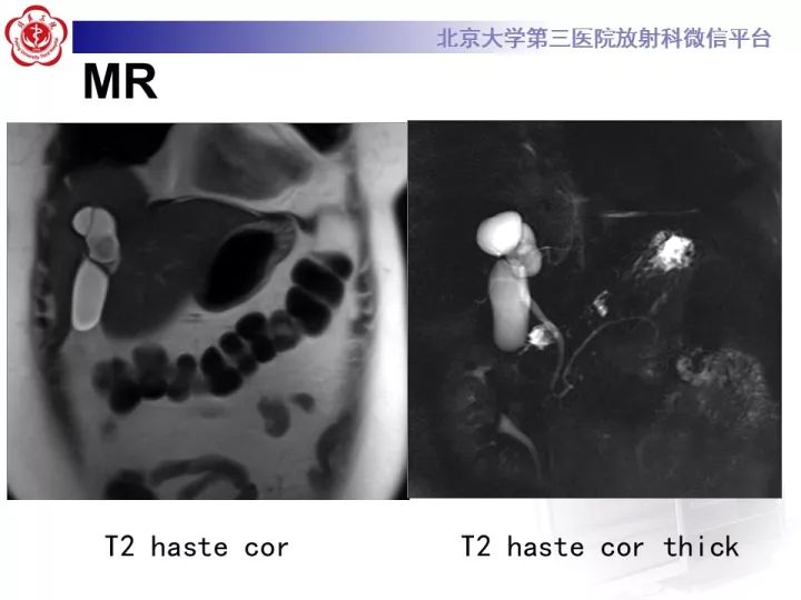 【病例】肝内胆管囊腺瘤1例CT及MR影像诊断
