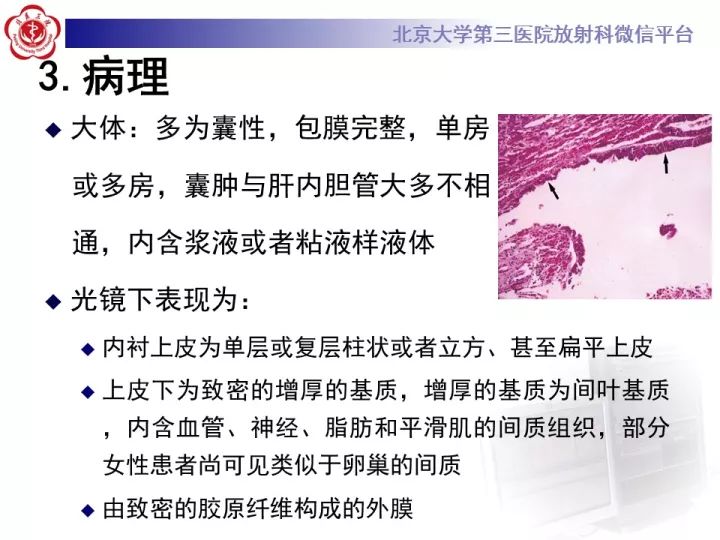 【病例】肝内胆管囊腺瘤1例CT及MR影像诊断