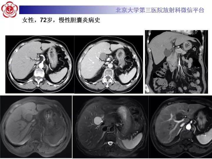 【病例】肝内胆管囊腺瘤1例CT及MR影像诊断