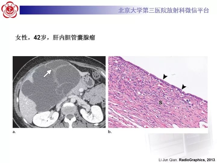 【病例】肝内胆管囊腺瘤1例CT及MR影像诊断