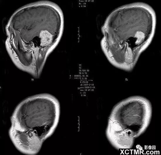 【病例】小脑孤立性纤维瘤1例MR影像诊断 【病例】小脑孤立性纤维瘤1例MR影像诊断