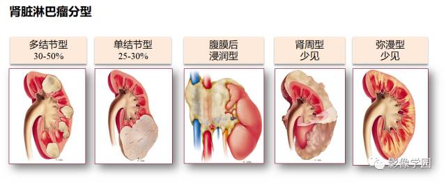 【病例】肾脏恶性淋巴瘤1例MR影像诊断 【病例】肾脏恶性淋巴瘤1例MR影像诊断
