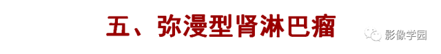 【病例】肾脏恶性淋巴瘤1例MR影像诊断 【病例】肾脏恶性淋巴瘤1例MR影像诊断