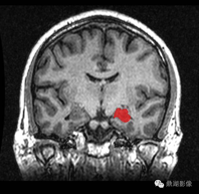 海马解剖及影像学评估 海马解剖及影像学评估