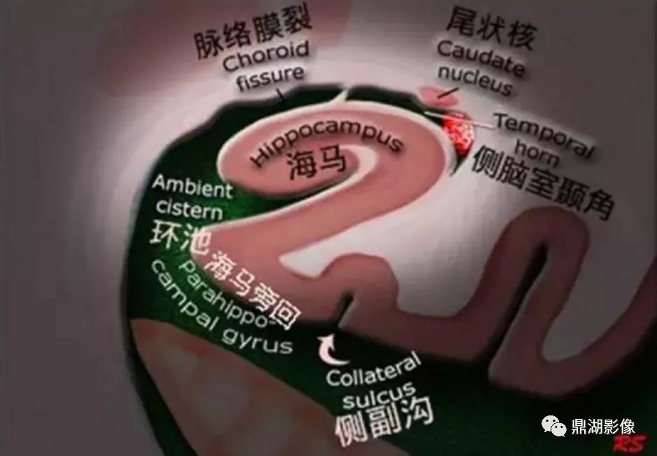 海马解剖及影像学评估 海马解剖及影像学评估