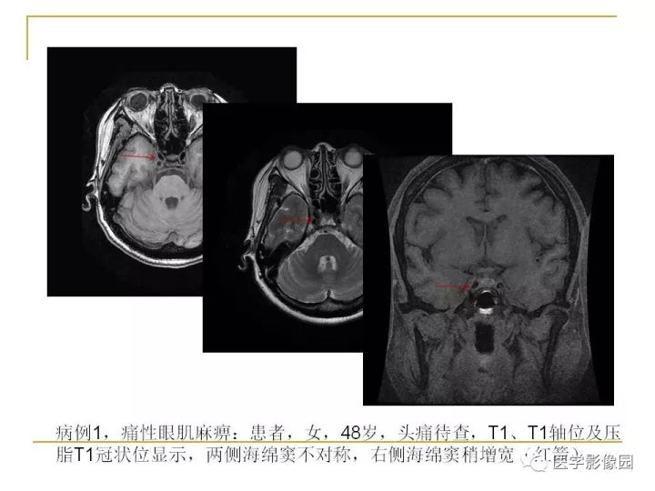 【PPT】痛性眼肌麻痹综合征（Tolosa-Hunt综合征）临床及影像