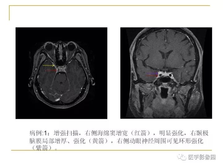 【PPT】痛性眼肌麻痹综合征（Tolosa-Hunt综合征）临床及影像