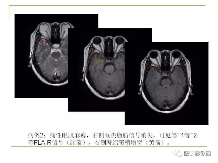 【PPT】痛性眼肌麻痹综合征（Tolosa-Hunt综合征）临床及影像