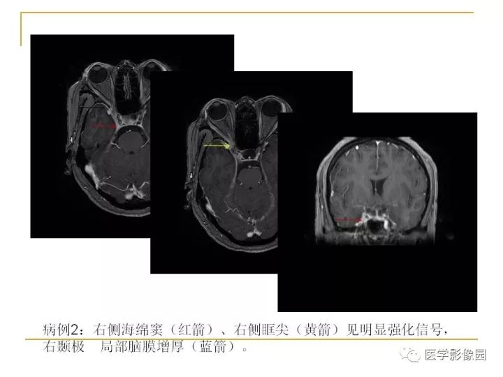【PPT】痛性眼肌麻痹综合征（Tolosa-Hunt综合征）临床及影像