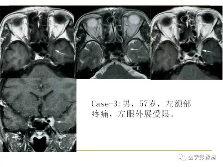 【PPT】痛性眼肌麻痹综合征（Tolosa-Hunt综合征）临床及影像