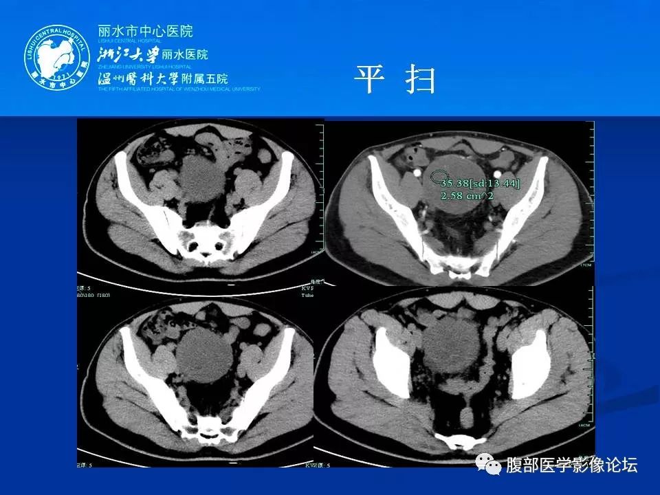 【病例】小肠系膜纤维瘤病1例CT