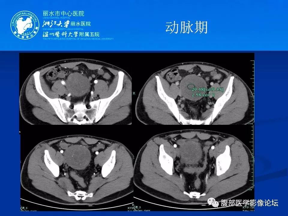 【病例】小肠系膜纤维瘤病1例CT
