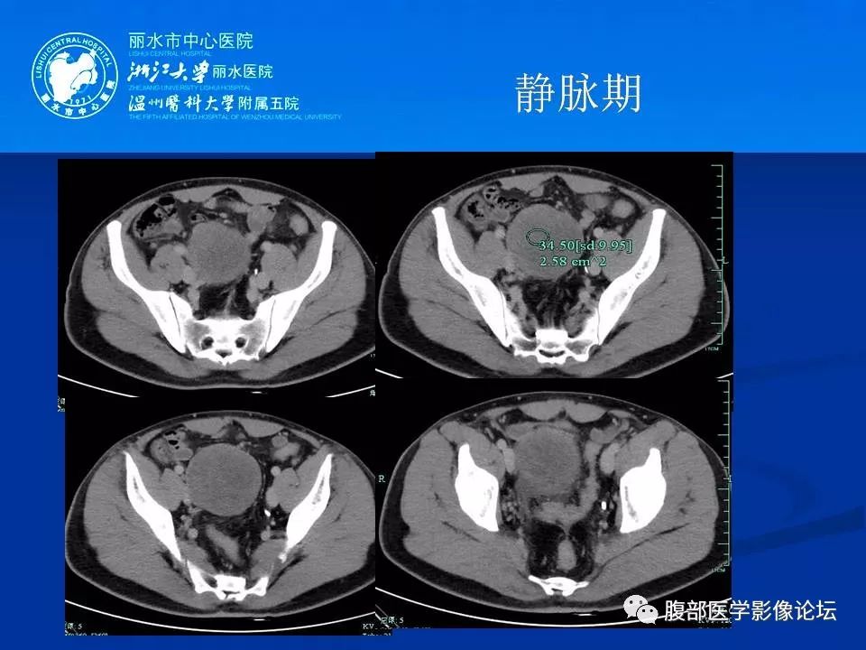 【病例】小肠系膜纤维瘤病1例CT