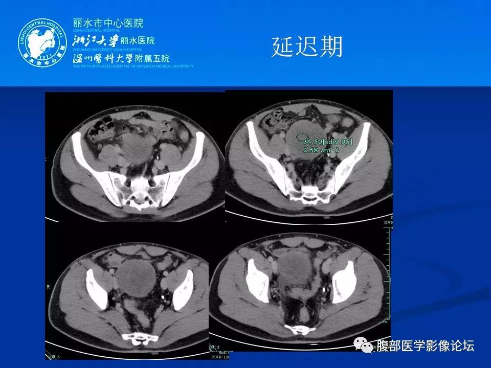 【病例】小肠系膜纤维瘤病1例CT