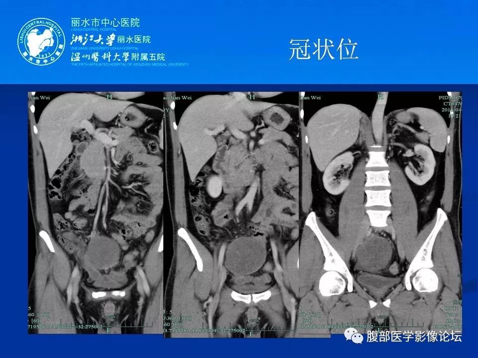 【病例】小肠系膜纤维瘤病1例CT