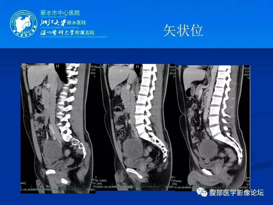 【病例】小肠系膜纤维瘤病1例CT